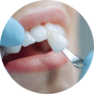 Laminate Treatment Guide image1